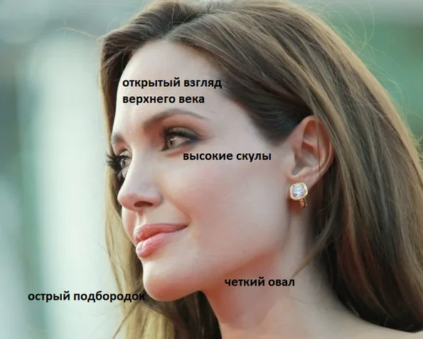 Коррекция углов нижней челюсти – Профиль Джоли